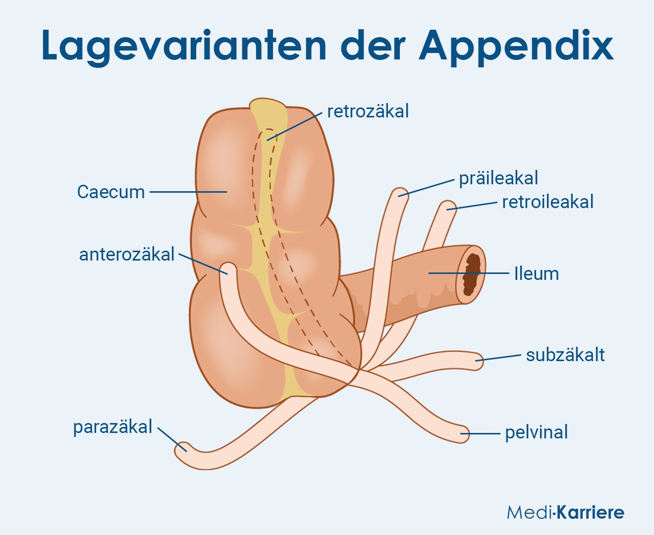 Appendix Vermiformis Wurmfortsatz Lage Anatomie Entz ndung